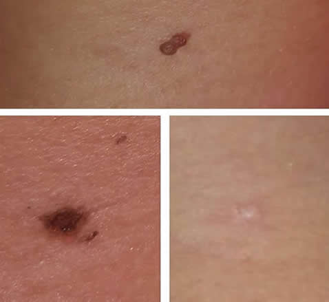 Skin Tag Removals